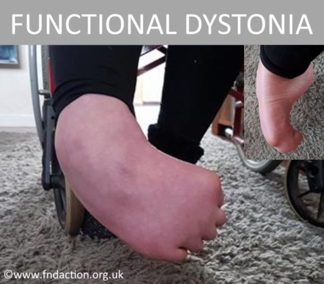 Supporting Dystonia Awareness Week 29th April7th May 2017